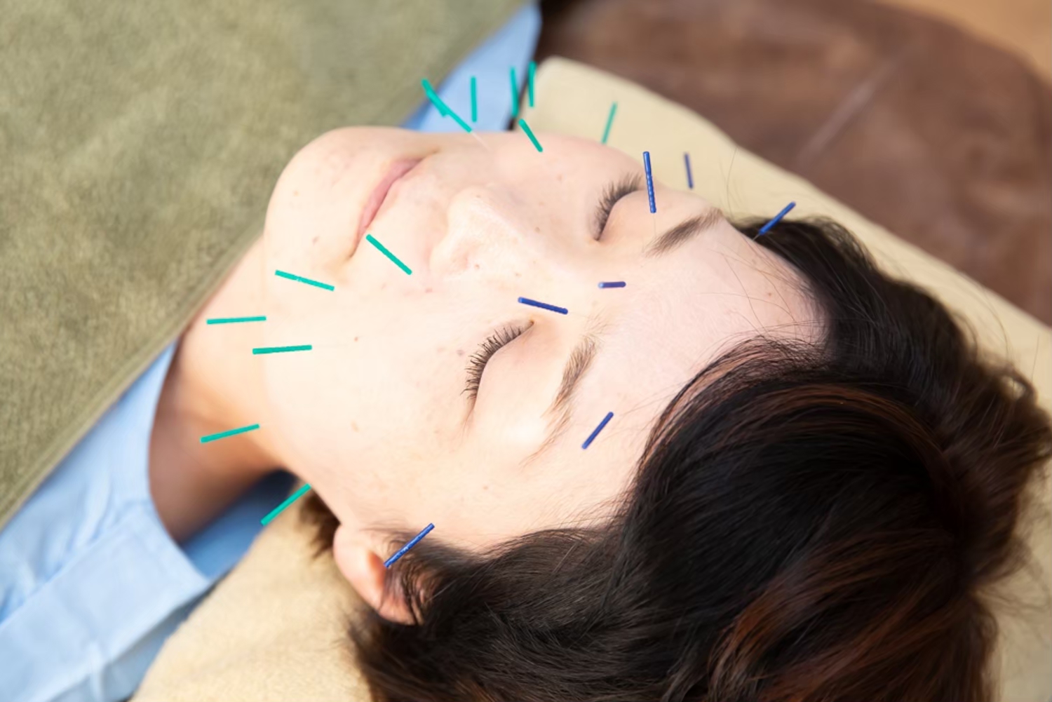 美容鍼　スクナビコナ鍼灸院奈良学園前