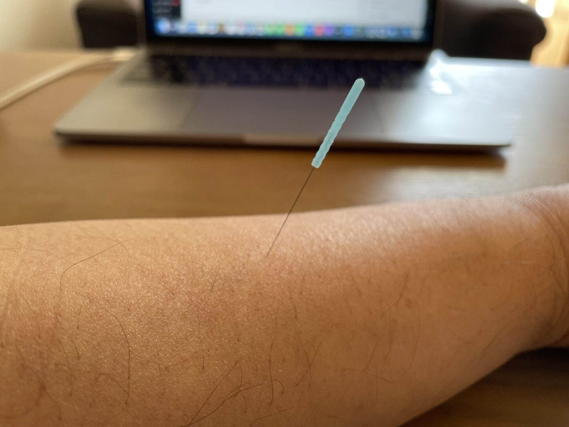 鍼を刺す様子