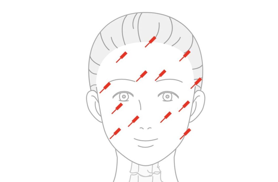 自律神経の不調を改善する鍼の位置を指名したイラスト