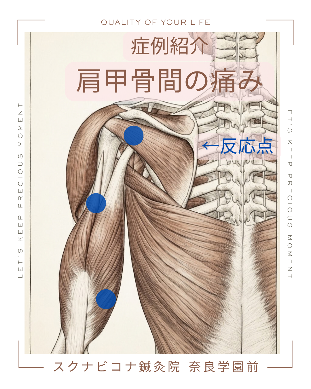 上腕三頭筋の反応点のイラスト